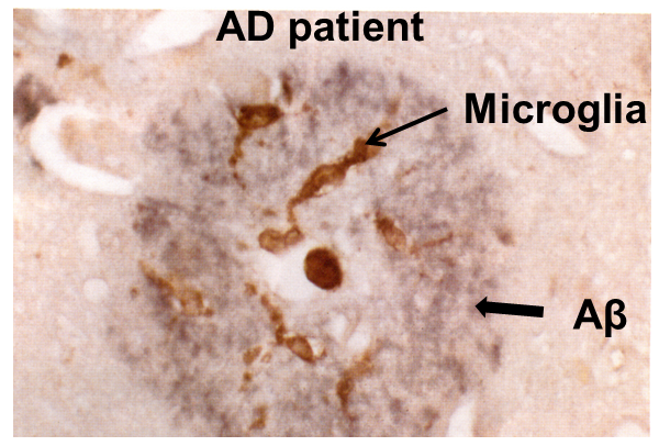 Microglia clustered around beta-amyloid deposition in Alzheimer's disease tissue